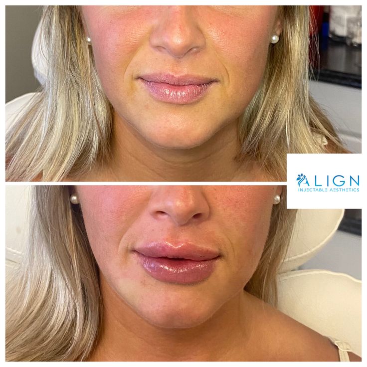 Lip filler maintenance with Versa. Lip Filler, Lip Fillers, Body Mods, Lips