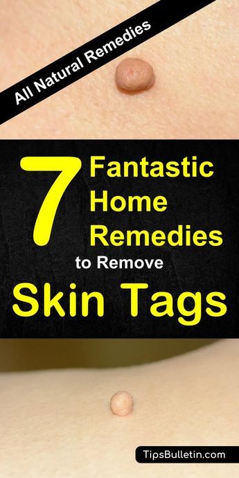 7 Fantastic Home Remedies To Remove Skin Tags - including skin tags removal at home quickly and naturally. Using essential oils, apple cider vinegar, oregano or tea tree oil or various other natural products. Perfect to get rid of skin tags on face, around eyes or under arms.#skintag #removeskintag #health #skin Skin Tags Removal, Skin Tags On Face, Remove Skin Tags, Home Remedies For Skin, Endocannabinoid System, Skin Tags, Cold Sores Remedies, Using Essential Oils, Natural Cold Remedies