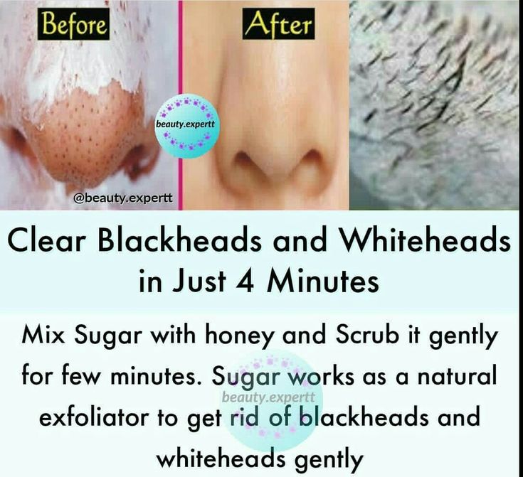 Clear Skin Remedies, Clear Skin Fast, 11th Chemistry, Clear Blackheads, Oven Bread, Beauty Tips In Urdu, Clear Skin Face, Black Heads, Natural Face Skin Care