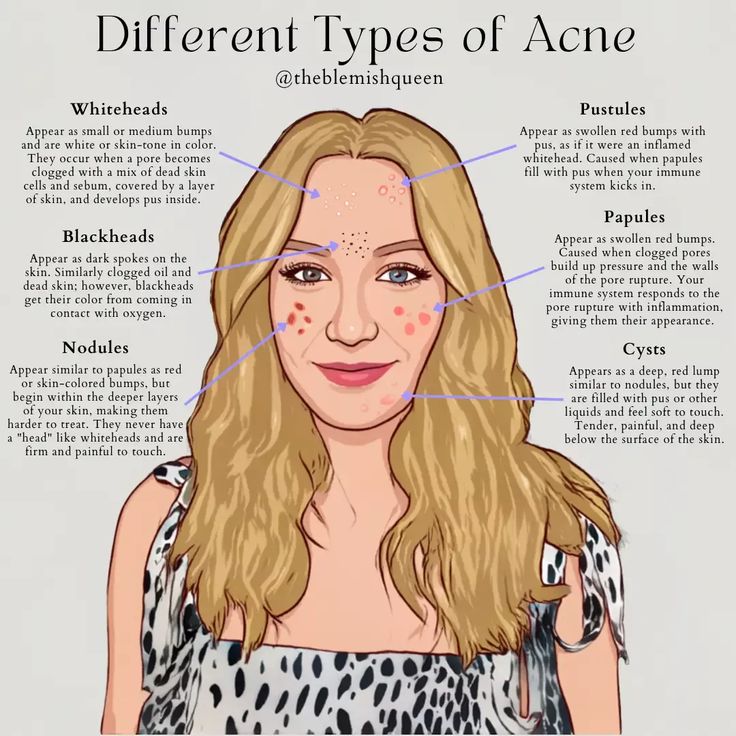 Acne types How To Close Pores On Face, Close Pores On Face, How To Close Pores, Acne Types, Closed Comedones, Pores On Face, Acne Routine, Different Types Of Acne, Mild Acne