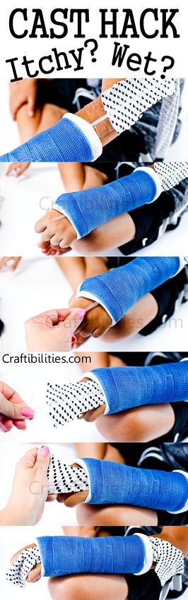 Itchy cast? Wet cast? This helps relieve an itchy spot or help soak up excess water or at least put something between the wet cast and skin. Cast Designs Arm, Cast Art Arm, Crutches Workout, Arm Cast Decorating Ideas, Cast Colors, Cast Covers Arm, Tattoo Back Of Arm, Tree Sleeve, Arm Cast