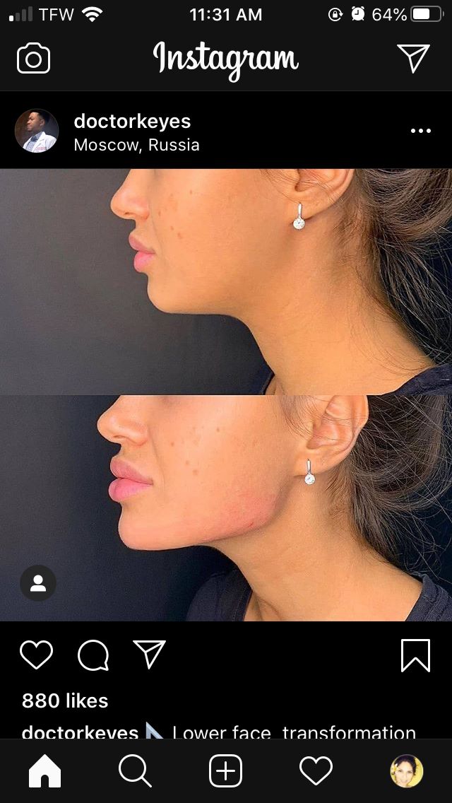 Chin Injection Before And After, Face Fillers Before And After, Jaw Filler Before And After, Fillers Before And After, Jawline Fillers Before And After, Facial Balancing Filler, Chin Fillers Before After, Filler Transformation, Nose Filler