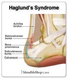 Haglund's Syndrome - inflammation in the Achilles tendon and retrocalcaneal bursa. Achilles Bursitis, Haglunds Deformity, Achilles Pain, Foot Anatomy, Achilles Tendon, Hockey Skates, Greek Warrior, Athletic Training, Foot Health