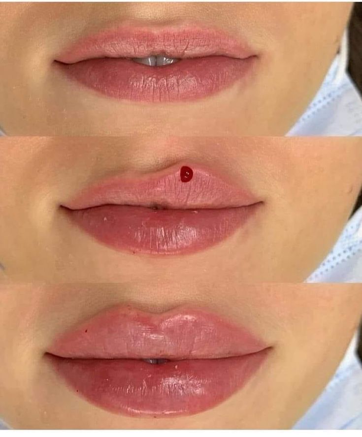 Lip Injections Heart Shape, Lip Injections Inspiration, Lip Filler Inspiration Heart Shaped, Keyhole Pout Lip Filler, Jolie Lip Filler, 1.5 Ml Lip Filler, Lip Filler Lips, 1ml Lip Filler Shapes, Lip Fillers Before And After 1ml Russian