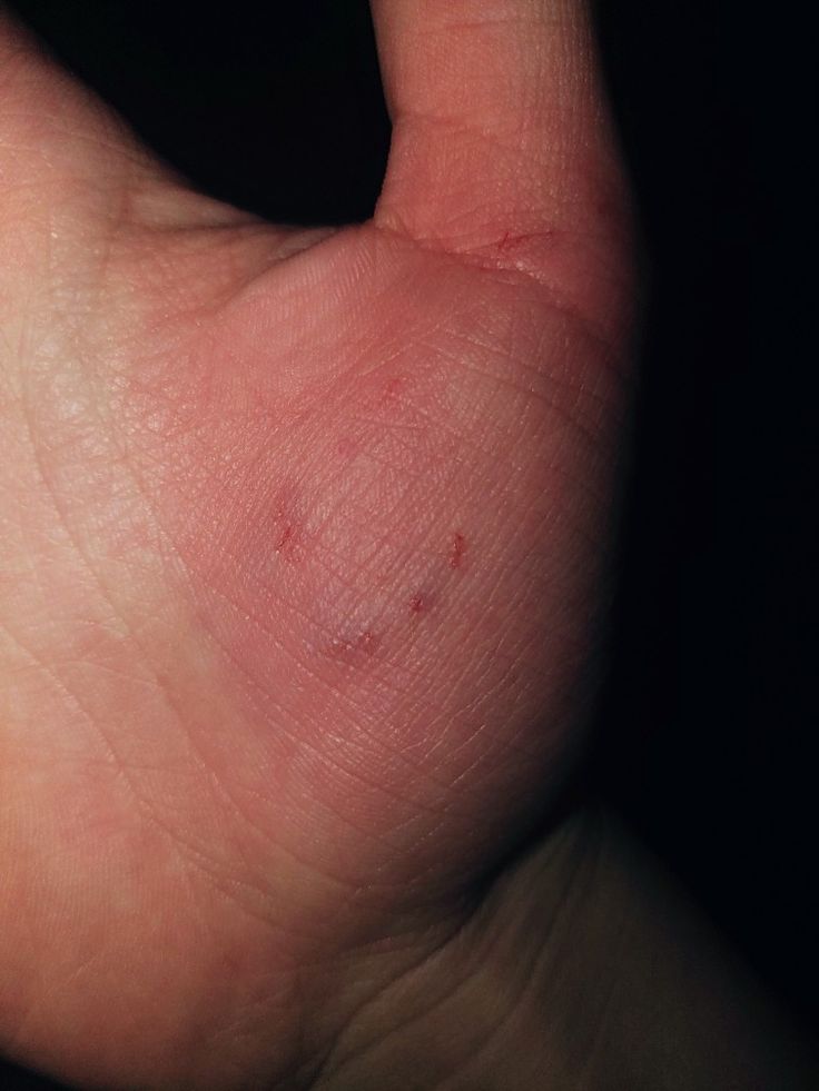 a person's left hand with red marks on the middle part of their thumb