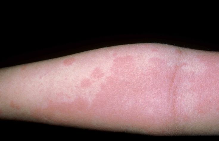 What 9 Common Skin Rashes Look Like Skin Rashes Pictures, Red Skin Spots, Common Skin Rashes, Allergy Rash, Food Allergy Symptoms, Facial Warts, Common Food Allergies, Red Rash, Skin Rashes