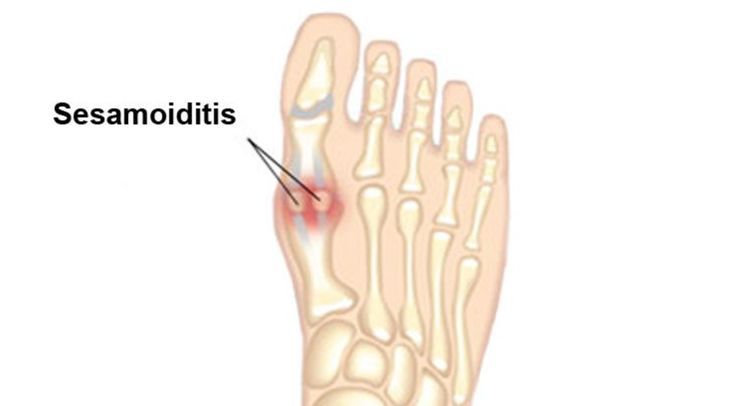 Physicians define “Sesamoids” as a classification of bone within the body that does not connect to any other bone or joint, connecting instead directly to tendons or muscles. The largest and most recognizable Sesamoid would include the kneecap, but the two small sesamoids found on the underside of the big toe can potentially cause issues with the foot. Sesamoid Bone, Oil Pulling Benefits, Make Coconut Milk, Ingrown Nail, Foot Injury, Oil Pulling, Muscle Tissue, Chronic Inflammation, Fall Prevention