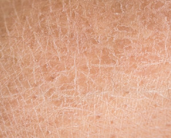 Dealing with Diabetic Skin Care Problems Scale Skin, Scaly Skin, Skin Disorders, Flaky Skin, Rough Skin, Itchy Skin, Dehydrated Skin, Skin Problems, Skin Conditions