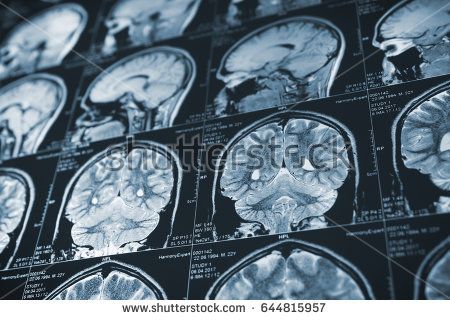 Brain Images, Brain Tissue, Ct Scan, Medical Imaging, Horror Novel, Human Head, Brain Function, Alzheimers, Brain Health