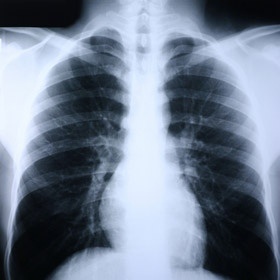 an x - ray shows the chest and ribs