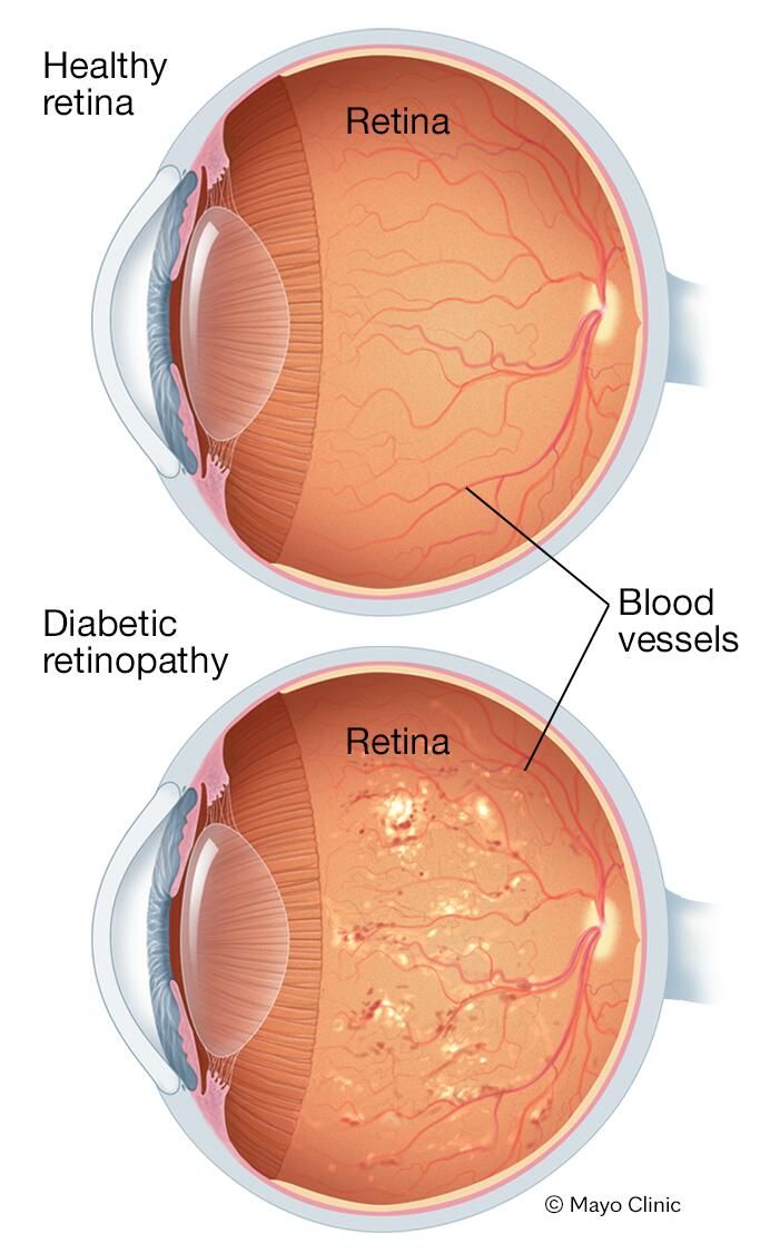 Vision Loss, Mayo Clinic, Disease, Quick Saves