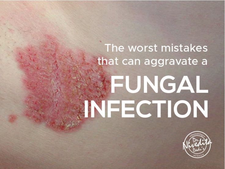 Fungal infection is an infectious skin condition  leading to irritation, scaly skin, redness, itching, swelling, and blisters. It can take place anywhere on the body. Once fungal infection is acquired, it takes quite some time to get rid of it.    Read the blog and find out the worst mistakes that can aggravate a fungal infection Staphylococci Bacteria Infection On Skin, Skin Rash Remedies, Fungal Rash, Fungal Infection Remedies, Skin Fungus, Rashes Remedies, Fungal Infection Skin, Sick Remedies, Scaly Skin