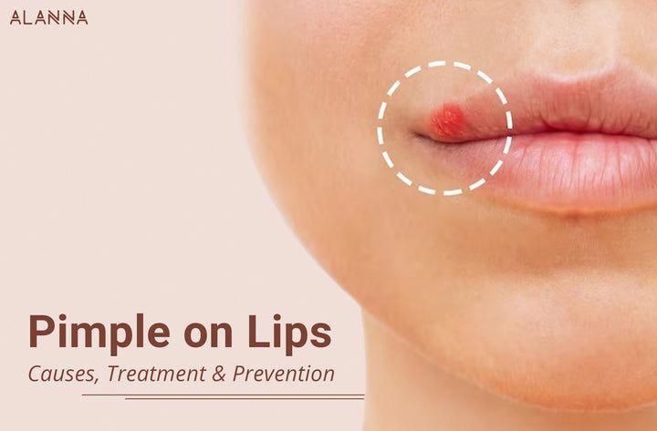 Pimples Around Lips, What Causes Pimples, Lip Pimple, Zit Remedy, Upper Lip Hair Removal, Reduce Hair Growth, Lip Hair Removal, Blind Pimple, Upper Lip Hair