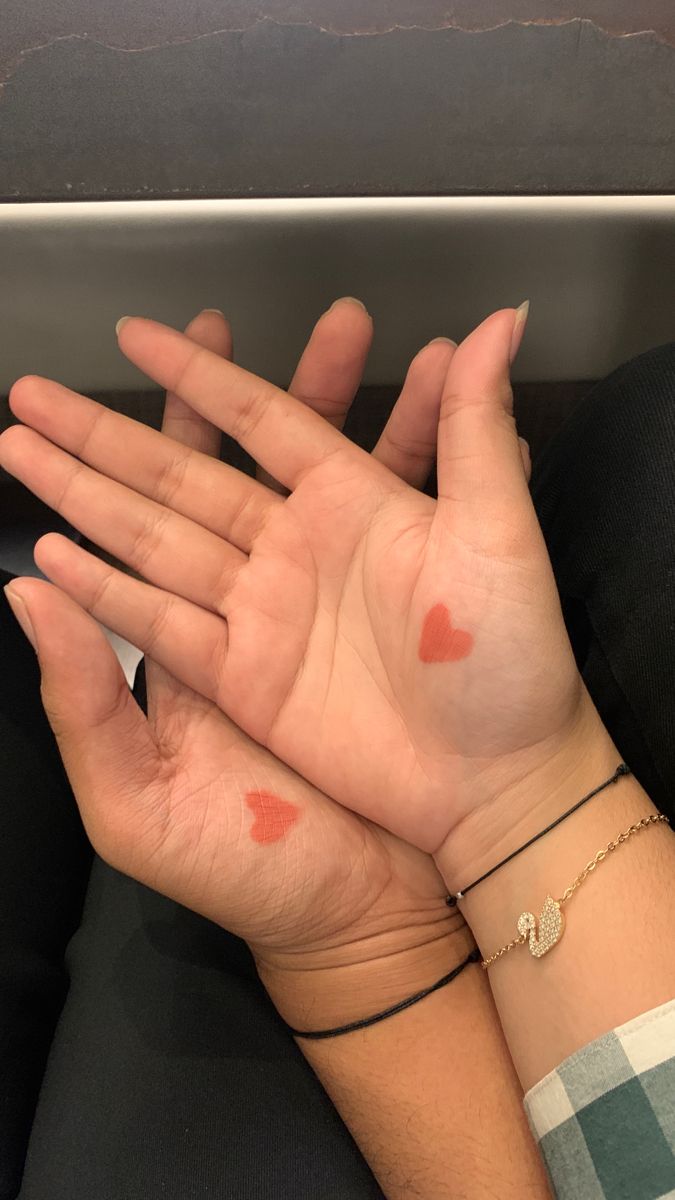 two hands with small red spots on their palms, one holding the other's hand