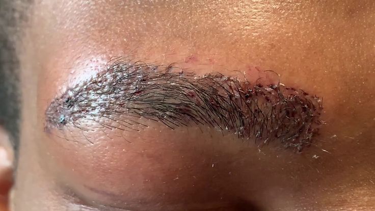 African-American Male Eyebrow Hair Transplant Close-up 1 Day Out Eyebrow Transplant Before After, Eyebrow Implants, Eyebrow Hair Transplant, Eyebrow Transplant, Black Person, Hair Transplant, Hair Restoration, Before And After Pictures, Behind Ear Tattoo