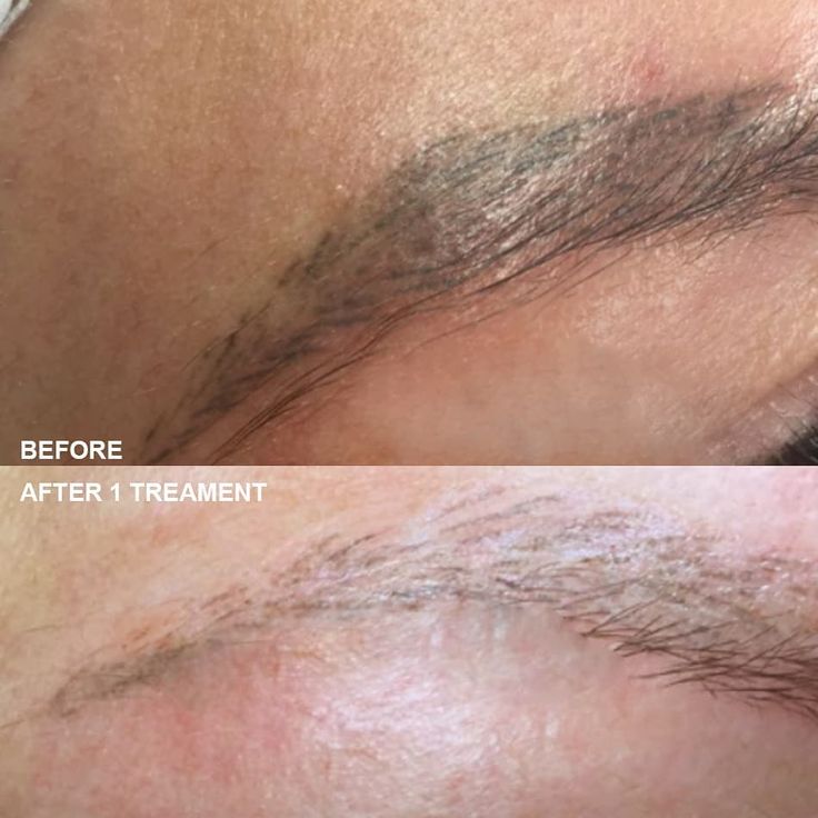 Remove Eyebrow Tattoo, Permanent Makeup Removal, Phi Academy, Eyebrow Tattoo Removal, Makeup Removal, Microblading Eyebrows, Eyebrow Tattoo, Healthy Beauty, Tattoo Removal