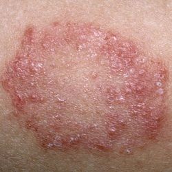 How To Treat Ringworm Fungal Rash, Yeast Infection Causes, Varicose Vein Removal, Vein Removal, Skin Rashes, Skin Disorders, Fungal Infection, Nail Fungus, Skin Problems