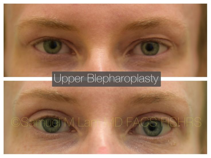 Upper Blephoraplasty, Upper Blephoraplasty Before And After, Blephoraplasty Before And After, Eyelid Filler, Mommy Makeover Surgery Recovery, Eye Lift Surgery, Aesthetic Procedures, Face Plastic Surgery, Botox Before And After