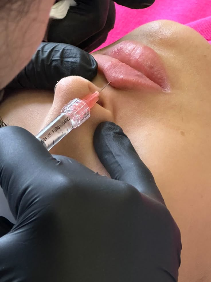 Dermal Fillers Lips, Esthetician Inspiration, Medical Esthetician, Aesthetic Nurse, Botox Lips, Face Mask For Blackheads, Lips Photo, Nurse Aesthetic, Skin Aesthetics