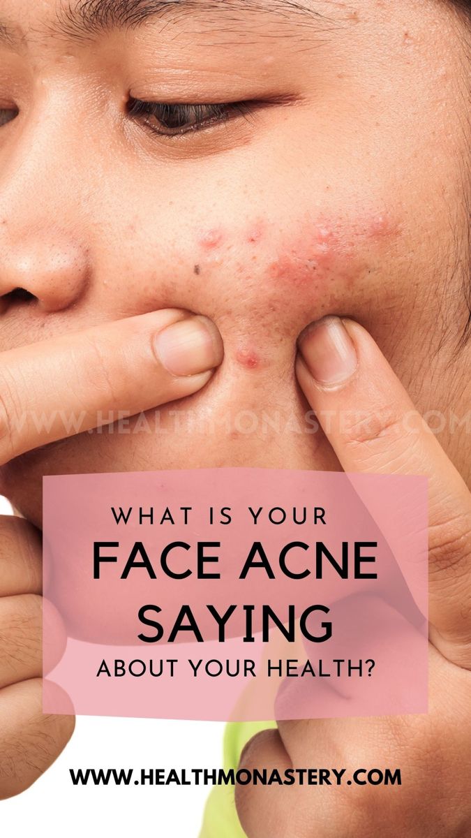 Acne Types Of Acne On Face, Acne Cheeks How To Get Rid, Jaw Line Acne, Jawline Acne Causes, Acne On Jawline, Cheek Pimples Cause, Why Do I Have Acne On My Cheeks, Acne On Jawline Meaning, Acne Map