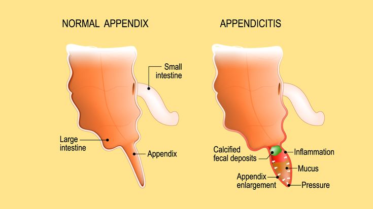 9 Appendicitis Symptoms You Should Know, According to Doctors Breastfeeding Poster, Intestines Anatomy, Loss Of Appetite, Nursing Cheat, Jerry Springer, Passing Gas, Medical Emergency, Feminine Health, Nature Wallpapers