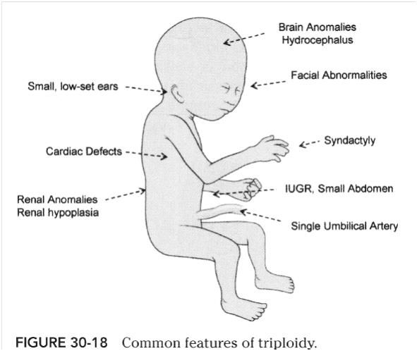 Characteristics of triploidy #ultrasound Ultrasound Sonography, Medical Ultrasound, Angel Babies, Biology Notes, Early Intervention, Ultrasound, Pediatrics, Biology, Nursing