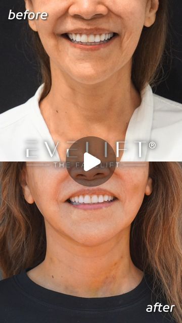 EVELift® on Instagram: "Natural Results That Keep Everybody Guessing. 🤫

Meet Sandy*, a youthful 62-year-old Miami native, who opted for our renowned EVELift® combined with volume restoration using fat.

Like many who seek our expertise, Sandy wanted a facial rejuvenation to address the sagging skin caused by years of gravity. “I was noticing saggy skin and lost a lot of volume in my face.”
After finding our practice, her facial rejuvenation journey began! This stunning 1-week before-and-after reel showcases Sandy’s incredible transformation: a youthful and natural look that resolved her concerns. We couldn’t be happier for her! ✨

#HappyPatient #FiveStarReview

Wondering why the EVELift®? 
 
Why patients choose us:
→ Natural results that keep everyone guessing
→ Faster recovery times + s Mini Face Lift, Local Anesthesia, Skincare Sunscreen, Neck Lift, Facial Rejuvenation, Saggy Skin, Sagging Skin, Be Happier, Plastic Surgeon