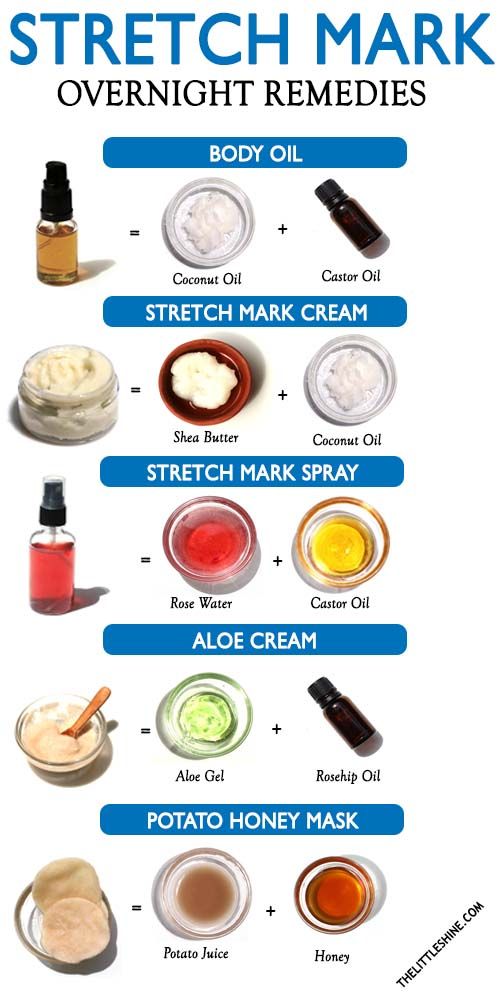 Stretch marks are more common than you think and can be a result of sudden weight gain or weight loss, pregnancy, obesity, contraceptive medicine side Overnight Remedies, Aloe Cream, Stretch Mark Remedies, Marks Cream, Potato Juice, Lotion For Oily Skin, Stretch Mark Cream, Stretch Mark Removal, Ayurvedic Remedies