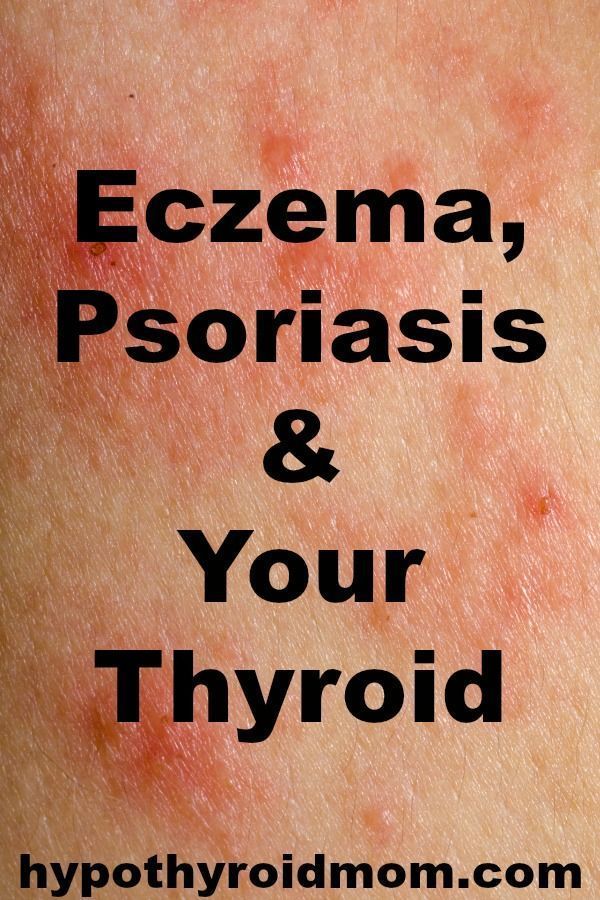 #eczema #psoriasis and your #thyroid HypothyroidMom.com Shampoo Diy, Thyroid Symptoms, Hashimotos Disease, Thyroid Issues, Thyroid Gland, Thyroid Health, Autoimmune Disease, What’s Going On, Young Living