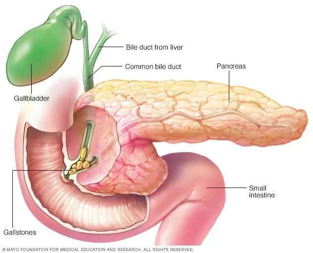 Pancreatitis - Symptoms and causes - Mayo Clinic Pancreatic Diet Recipes, Digestive System Disorders, Digestive Juice, Bile Duct, Types Of Cancers, Mayo Clinic, Chronic Inflammation, Medical Education, Anatomy