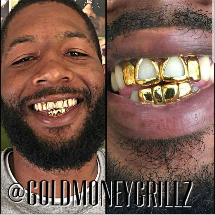 Removable Pullout grillz Shop Prices Dental gold—$35 per tooth Silver ---- $50 per tooth 10k ---------- $75 per tooth 14k ----------- $95 per tooth 18k ---------- $150 per tooth 22k~ $250 per tooth Missing Tooth/chip $30 extra per tooth Call 954-933-7029 Open Tooth Grill, One Tooth Grillz, Tooth Cap Grill, Africa Grillz Teeth, Gold Caps Teeth, Missing Tooth, Missing Teeth, Gold Money, Ear Rings