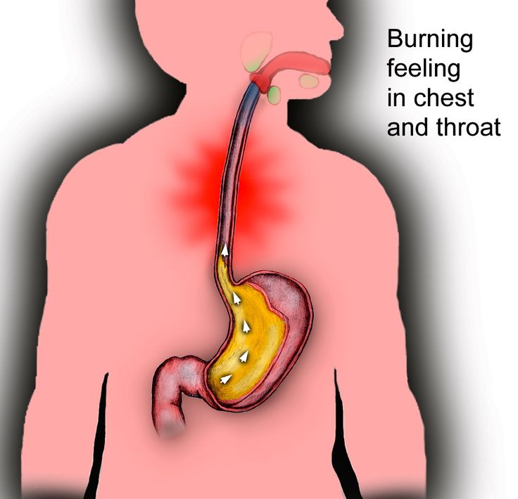 Stop Acid Reflux, Reflux Diet, Heart Burn Remedy, Acid Reflux Diet, Reflux Symptoms, Reflux Disease, Stomach Acid, Acid Reflux, Medical Prescription