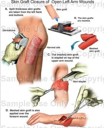 Burn Nursing, Nursing Burns, Burns Nursing, Nurse Ratchet, Sensory Organs, Nursing Procedures, Burn Care, Remedies For Skin, Ostomy Care