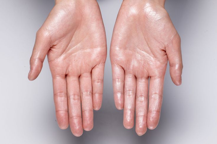 Sweaty Hands? Amazon’s Top-Ranked Antiperspirant Hand Lotion Can Help Skincare Boutique, Sistem Saraf, Sweaty Palms, Hand Sweating, Sweaty Hands, Beauty Procedures, Full Body Stretch, Chemical Peels, Disease Symptoms