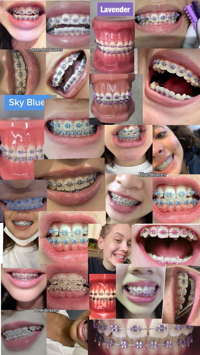 Blue 💙 Purple 💜 and Pink 💖 Perfect Teeth Braces, Dental Braces Colors, Pink Braces, Cute Braces Colors, Pretty Teeth, Braces Tips, Getting Braces, Cute Braces, Diamond Teeth