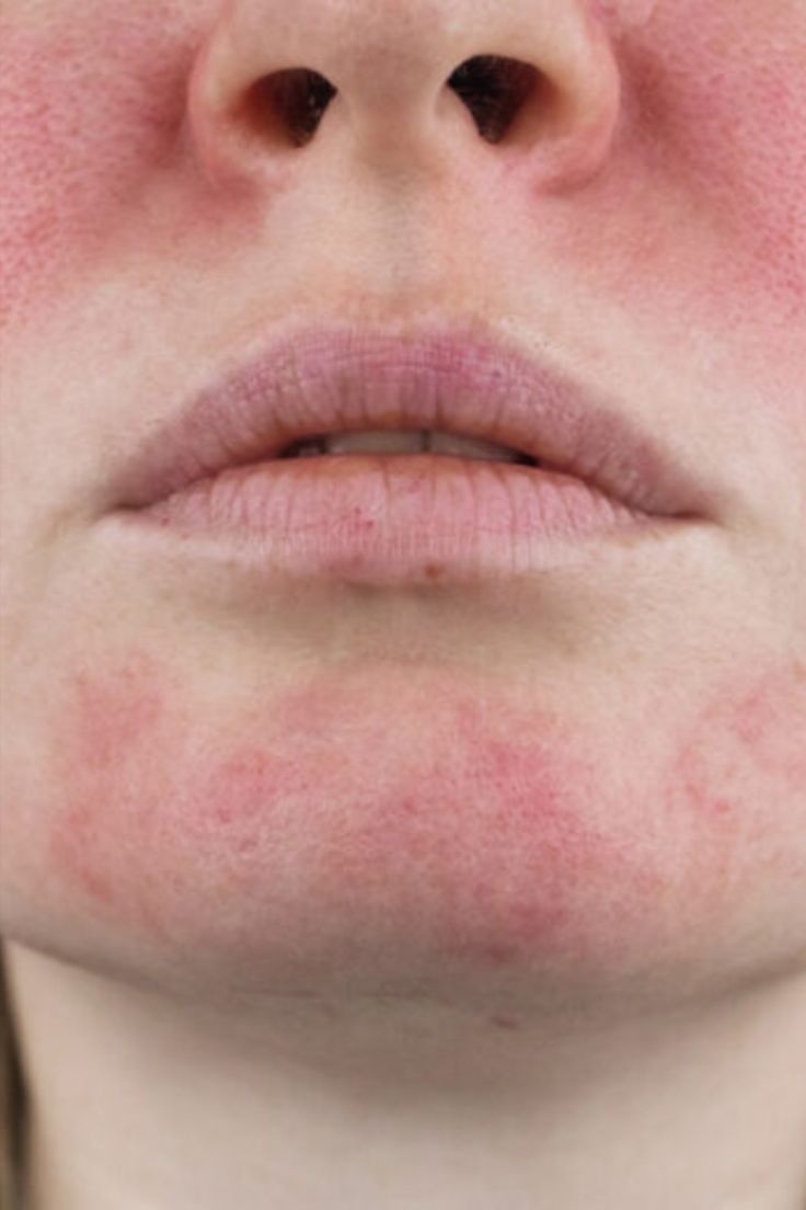 The National Rosacea Society (NRS) has introduced a new Seal of Acceptance program aimed at identifying skin care and cosmetic products that may be suitable for individuals suffering from rosacea. This chronic immune-mediated skin condition affects millions of people worldwide. It is characterized by symptoms such as inflamed bumps, redness, swelling, and visible blood vessels. Now, people who are suffering with flare-ups will have some guidance before adding to cart. Water Blister, Sustained Investigation, Red Rash, Inflamed Skin, Health Chart, Face Tips, A Seal, Clear Skin Tips, Healthier Skin