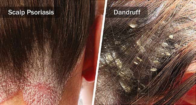 Scalp Psoriasis vs. Dandruff: How To Tell The Difference Scabs On Scalp How To Get Rid Of, Sebhorric Dermitis Scalp, Scalp Psorasischic, Scalp Psorasischic Remedies, How To Get Rid Of Dry Scalp, Dry Scalp Vs Dandruff, Scabs On Scalp, Itchy Scalp Remedy, How To Remove Dandruff