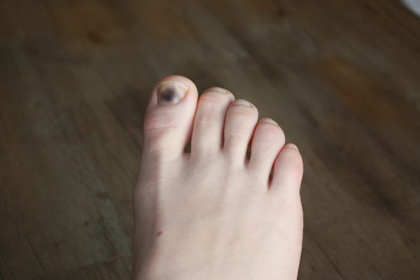 Dark, brittle or thick toenails can be caused by a number of irregularities in the nail bed, including trauma, fungal infections and ingrowth. Some will heal with time, but others may need doctoral intervention. The best ways to prevent irregularities are to trim the nails regularly, avoid acrylic nails, and wear the correct shoe size.... Dark Toenails, Nail Disorders, Toenail Health, Black Toe Nails, Nail Remedies, Acrylic Nail Liquid, Nail Infection, Fungal Nail, Nails Today