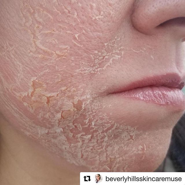 Such a good result by @beverlyhillsskincaremuse using the CosMedix Deep Sea Peel. While not everyone needs this level of peeling, for… Clinic Poster, Peeling Skin, Skin Diseases, Chemical Peel, Skin Texture, New Skin, Dull Skin, Dermatology, Face Skin