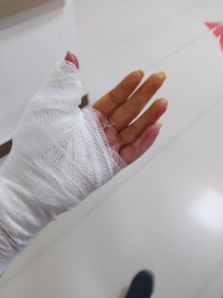 a woman's hand with bandages on it and another person holding something in the background