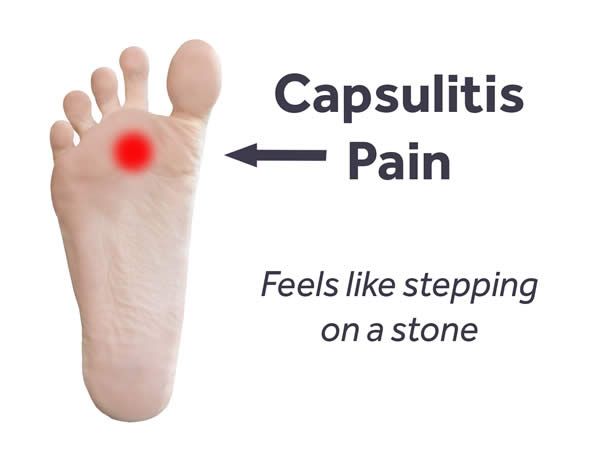 When you mention foot injuries, most people think of Achilles tendonitis, stress fractures or the dreaded plantar fasciitis. While these... Bottom Of Foot Pain Chart, Planterficitis Foot, Foot Pain Chart, Foot Pain Relief Remedies, Aching Knees, Morton's Neuroma, Kt Tape, Hip Problems, Foot Exercises