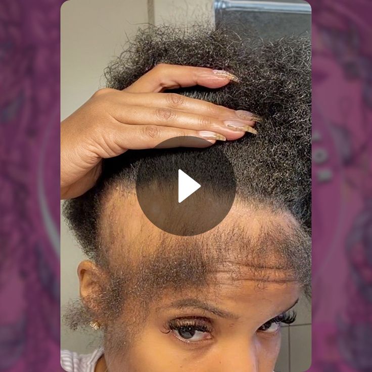 Fixing Edges Hairstyles To Protect Edges, Bald Edges Hairstyles Black Women, Protective Styles For Thinning Edges, Braids For Thinning Edges, No Edges Hairstyles Black Women, Doing Edges, Regrow Edges, Edges Hairstyles, Dramatic Edges