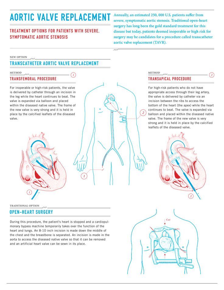 the diagram shows how heart valves are used to treat and treat for people with asthma