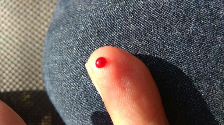 a person's finger with a red spot on their thumb and the tip of his thumb