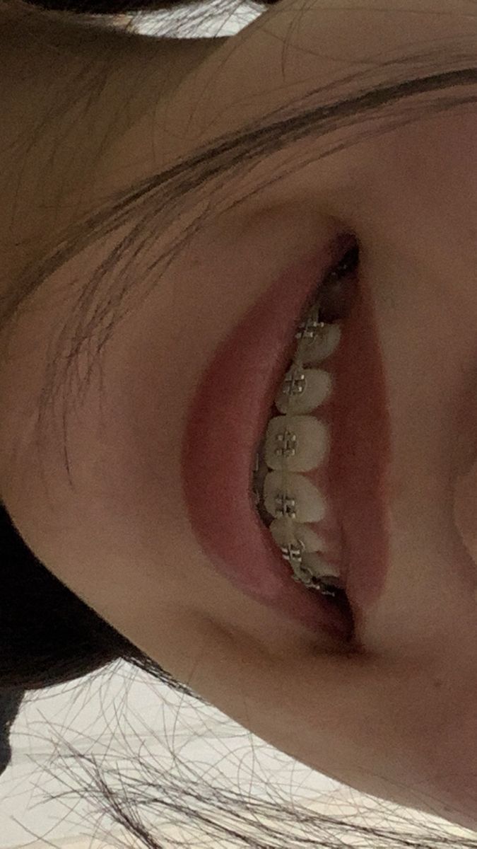 White Teeth Braces, Metal Braces Aesthetic, Burgundy Braces Color, Straight Teeth Braces, Braces Aesthetic Power Chain, Braces Vision Board, Silver Braces Aesthetic, Straight Teeth With Braces, Brace Aesthetics