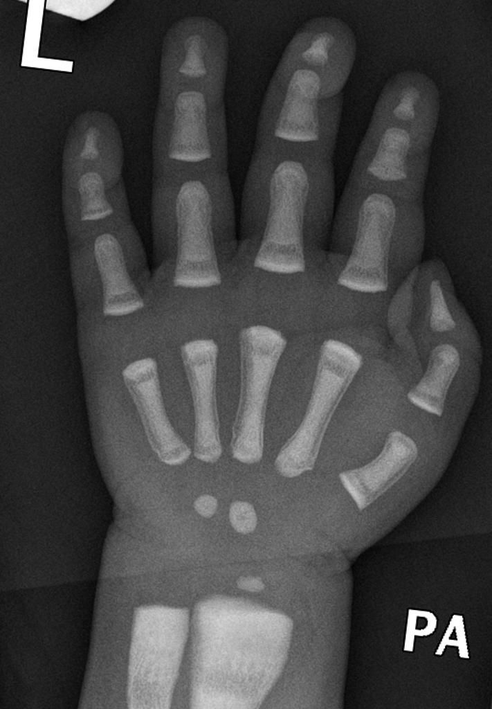 Osteopetrosis | Radiology Case | Radiopaedia.org Bone Fracture, Bone Diseases, Hand Pain, Bone Loss, Radiology, Medical Care, X Ray, Disease, Bones