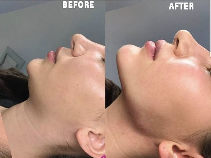 Face Plastic Surgery, Nose Surgery Rhinoplasty, Chin Filler, Chin Implant, Face Fillers, Face Surgery, Botox Lips, Face Lift Surgery, Cheek Fillers