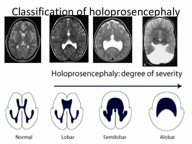 Holoprosencephaly Brain