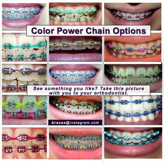 Color Power chains Brace Color Combinations, Braces Chain Colors, Purple Power Chain Braces, Cutest Braces Colors, Silver Power Chain Braces, Gold Braces With Color Bands, Power Chain Braces Colors, Braces Colors Ideas Power Chains, Braces Power Chain