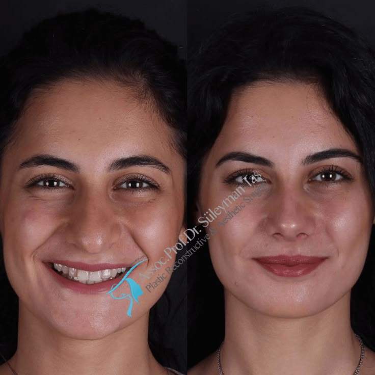 Rhinoplasty Gallery | Assoc. Prof. Dr. Suleyman TAS Rhinoplasty Nose Jobs, Rhinoplasty Before And After, Job Inspiration, Best Plastic Surgeons, Pretty Nose, Perfect Nose, Nose Surgery, Celebrity Plastic Surgery, Nose Job